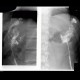 Chronic cavity and fistula after enucleation of pancreatic tumour: RF - Fluoroscopy