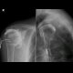 Fistulography of right shoulder: X-ray - Plain radiograph