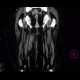 Phegmon of thigh: CT - Computed tomography