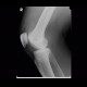 Fluid in suprapatellary recess on radiograph: X-ray - Plain radiograph