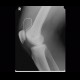 Fluid in suprapatellary recess on radiograph: X-ray - Plain radiograph