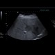 Focal fatty sparing: US - Ultrasound