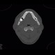 Follicular cyst: CT - Computed tomography