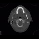 Follicular cyst: CT - Computed tomography