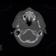Follicular cyst: CT - Computed tomography