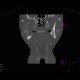 Follicular cyst: CT - Computed tomography