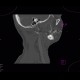 Follicular cyst: CT - Computed tomography