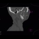 Follicular cyst: CT - Computed tomography