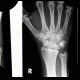 Fracture of scaphoid bone, decalcination of the fracture line, three weeks after trauma: X-ray - Plain radiograph