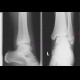 Fracture of lateral ankle, distal fibula, Weber B, subluxation of talus: X-ray - Plain radiograph