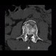 Fracture of lumbar vertebra, comminuted, burst fracture: CT - Computed tomography