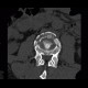 Fracture of lumbar vertebra, comminuted, burst fracture: CT - Computed tomography