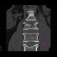 Fracture of lumbar vertebra, comminuted, burst fracture: CT - Computed tomography