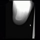 Fracture of calcaneus, atypical: X-ray - Plain radiograph