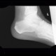 Fracture of calcaneus, atypical: X-ray - Plain radiograph