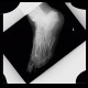 Fracture of calcaneus, atypical: X-ray - Plain radiograph