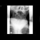 Fracture of dens axis: X-ray - Plain radiograph
