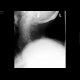 Fracture of dens axis: X-ray - Plain radiograph
