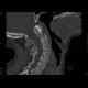 Fracture of dens axis: CT - Computed tomography
