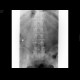 Compression fracture of lumbar vertebra: X-ray - Plain radiograph