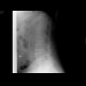 Compression fracture of lumbar vertebra: X-ray - Plain radiograph