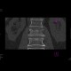 Compression fracture of lumbar vertebra: CT - Computed tomography
