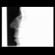Fracture of nasal bones: X-ray - Plain radiograph