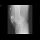 Fracture of patella: X-ray - Plain radiograph