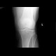 Fracture of patella: X-ray - Plain radiograph