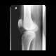 Fracture of patella: X-ray - Plain radiograph