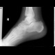 Comminuted fracture of calcaneus: X-ray - Plain radiograph