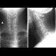 Fracture of the spinous process C6 - Clay shoveler's fracture: X-ray - Plain radiograph