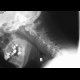 Fracture of the spinous process C6 - Clay shoveler's fracture: X-ray - Plain radiograph