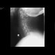 Fracture of the spinous process C6 - Clay shoveler's fracture: X-ray - Plain radiograph