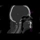 Fracture of the spinous process C6 - Clay shoveler's fracture: CT - Computed tomography