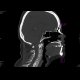 Fracture of the spinous process C6 - Clay shoveler's fracture: CT - Computed tomography