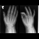 Fracture of radial styloid process and base of 5th metacarpal bone: X-ray - Plain radiograph