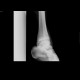 Comminuted fracture of talus: X-ray - Plain radiograph