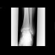 Comminuted fracture of talus: X-ray - Plain radiograph