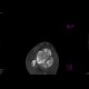 Comminuted fracture of talus: CT - Computed tomography