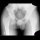 Avulsion of ischial tuberosity: X-ray - Plain radiograph