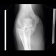 Monteggia fracture of proximal ulna and head of radius, type II: X-ray - Plain radiograph
