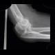 Monteggia fracture of proximal ulna and head of radius, type II: X-ray - Plain radiograph