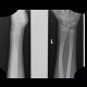 Greenstick fracture of radius: X-ray - Plain radiograph