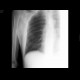 Rib fracture: X-ray - Plain radiograph