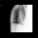 Rib fracture: X-ray - Plain radiograph