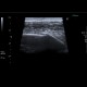 Fracture of rib, recognized on ultrasound: US - Ultrasound