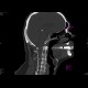 Fracture of dens axis: CT - Computed tomography