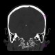 Fracture of dens axis: CT - Computed tomography