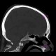 Fracture of dens axis: CT - Computed tomography